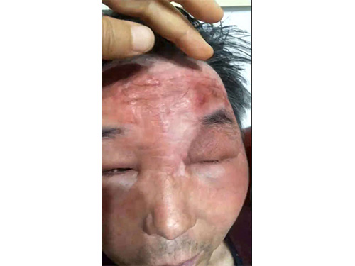 客户男，五十八岁，脸部浮肿的的历害，在潍坊（医院）住院！
